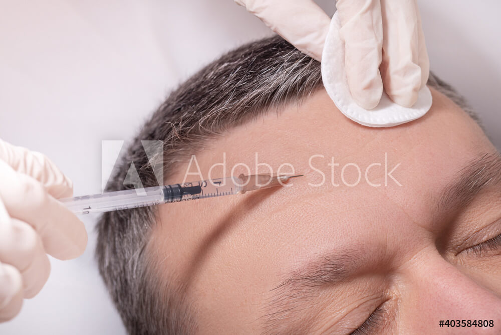 Forehead lines